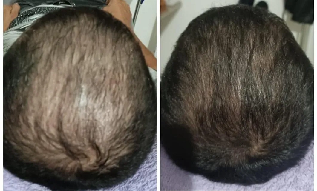 Cuero cabelludo antes y después de un tratamiento capilar