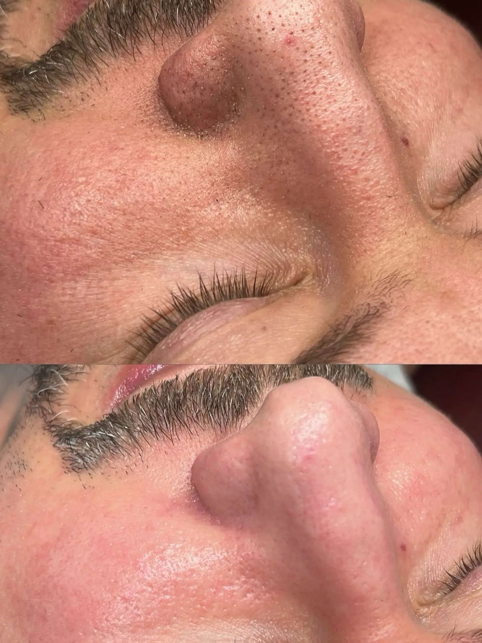 Piel de la nariz antes y después de una limpieza facial